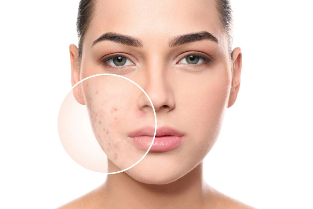 Clear Skin Ahead