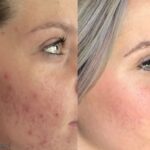 Advanced skincare treatment results